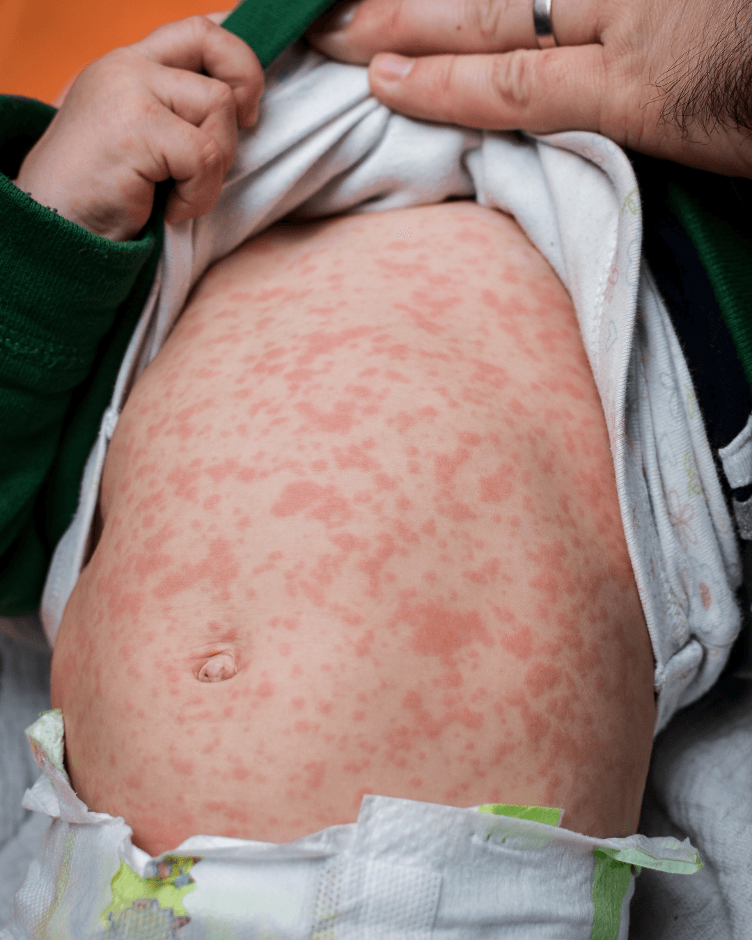 SP alerta para vacinação após novos casos de sarampo